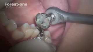 イージークラウンリムーバー｜株式会社フォレスト・ワン 矯正歯科