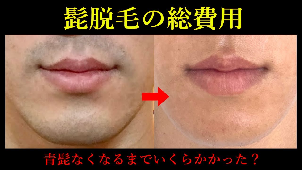 Lowest Price] I have successfully had my beard removed, so I will